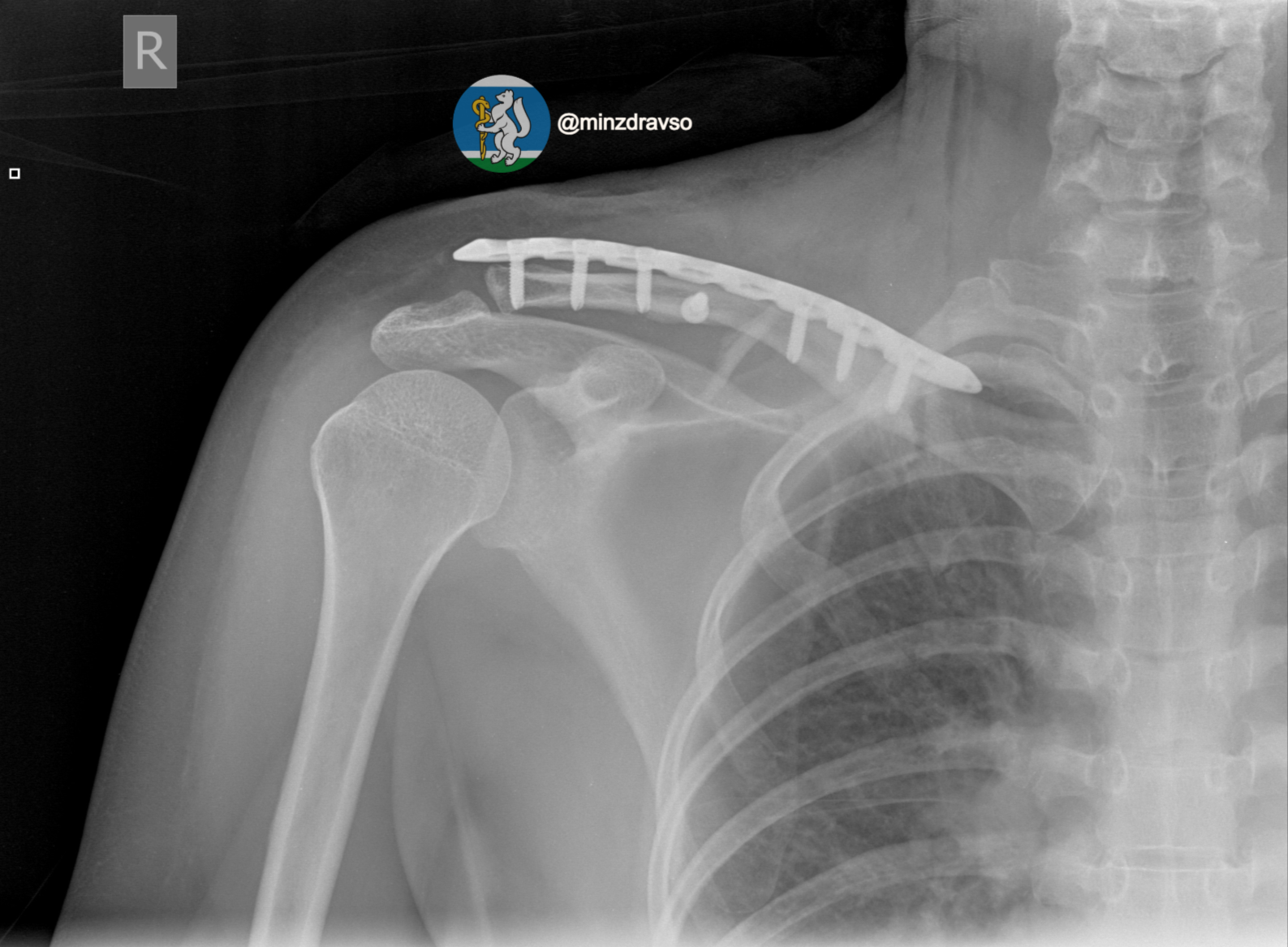 Свердловские врачи спасли женщину, которую переехал автомобиль