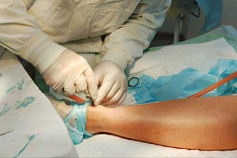 Лечение варикоза лазером стало доступно жителям Асбеста по ОМС